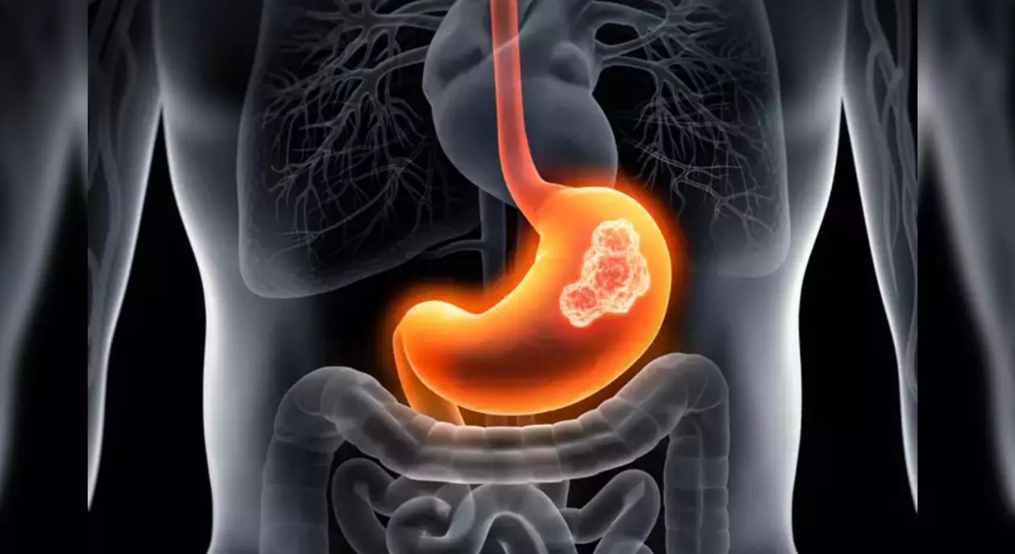 Có dấu hiệu này suốt nửa năm nhưng không đi khám, thanh niên 17 tuổi mắc ung thư giai đoạn cuối - Ảnh 1.