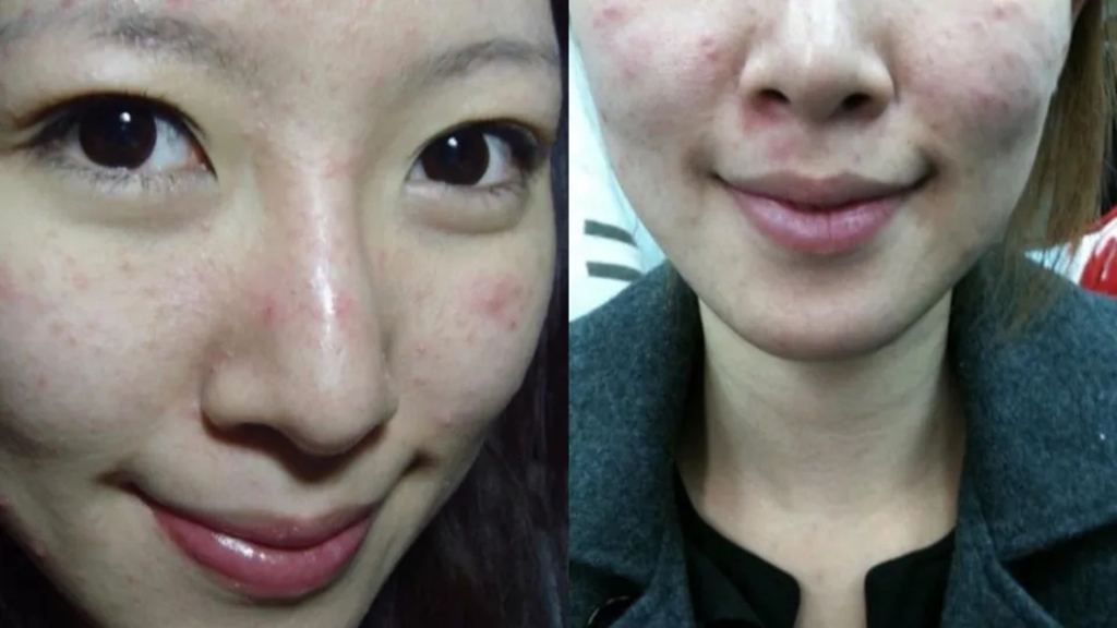 Nữ nghệ sĩ khổ sở v&igrave; bệnh da suốt 7 năm, s&aacute;ng soi gương l&agrave; bật kh&oacute;c: B&aacute;c sĩ cảnh b&aacute;o bệnh trứng c&aacute; đỏ kh&ocirc;ng chỉ li&ecirc;n quan đến da mặt - Ảnh 2.