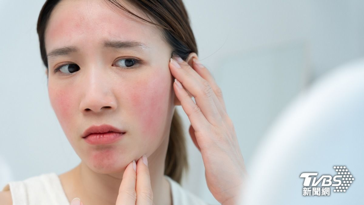 Nữ nghệ sĩ khổ sở v&igrave; bệnh da suốt 7 năm, s&aacute;ng soi gương l&agrave; bật kh&oacute;c: B&aacute;c sĩ cảnh b&aacute;o bệnh trứng c&aacute; đỏ kh&ocirc;ng chỉ li&ecirc;n quan đến da mặt - Ảnh 3.