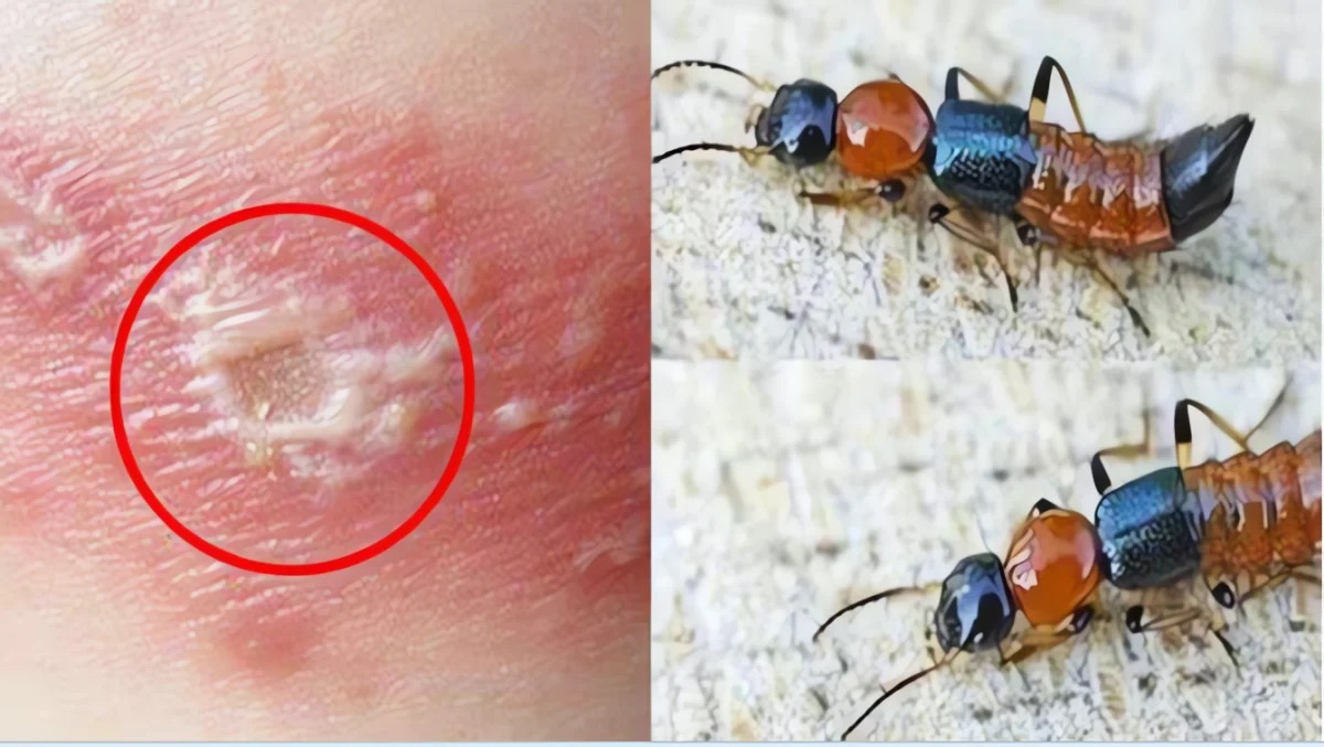 Kiến ba khoang "v&agrave;o m&ugrave;a", cẩn trọng dễ nhầm với zona thần kinh - Ảnh 2.