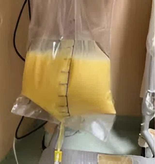 Người phụ nữ 30 tuổi "m&aacute;u trắng đục như sữa" v&igrave; th&oacute;i quen nhiều người mắc m&agrave; kh&ocirc;ng hay- Ảnh 1.