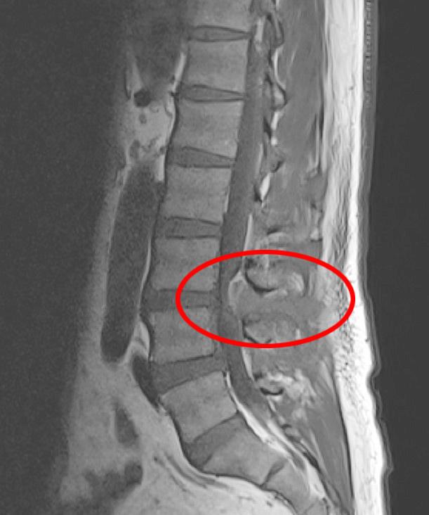 Uống thuốc c&uacute;m m&atilde;i kh&ocirc;ng khỏi, người đ&agrave;n &ocirc;ng đi kh&aacute;m ph&aacute;t hiện đốt sống bị vi khuẩn ph&aacute; hủy - Ảnh 3.
