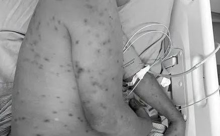 Bị hơn 300 con ong đốt, người đ&agrave;n &ocirc;ng 62 tuổi nguy kịch - Ảnh 1.