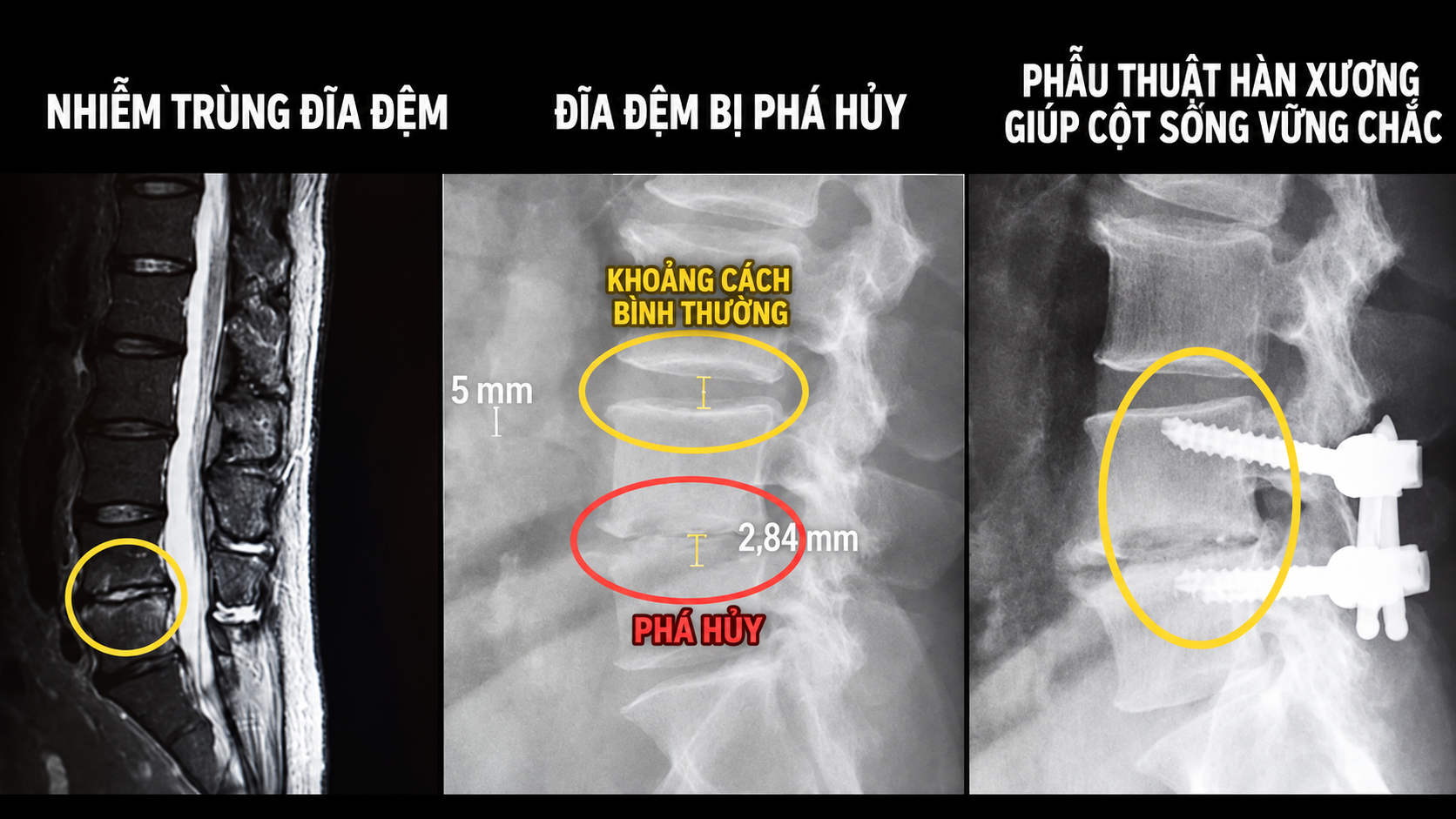 Uống thuốc c&uacute;m m&atilde;i kh&ocirc;ng khỏi, người đ&agrave;n &ocirc;ng đi kh&aacute;m ph&aacute;t hiện đốt sống bị vi khuẩn ph&aacute; hủy - Ảnh 1.