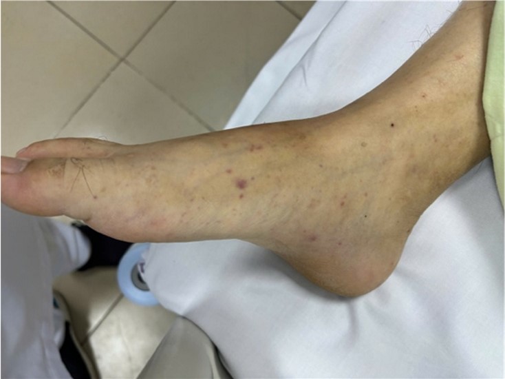 Th&ecirc;m một ca n&atilde;o m&ocirc; cầu tại TPHCM, trẻ đ&atilde; ti&ecirc;m vaccine vẫn mắc bệnh: B&aacute;c sĩ cảnh b&aacute;o 4 nh&oacute;m người c&oacute; nguy cơ cao - Ảnh 3.