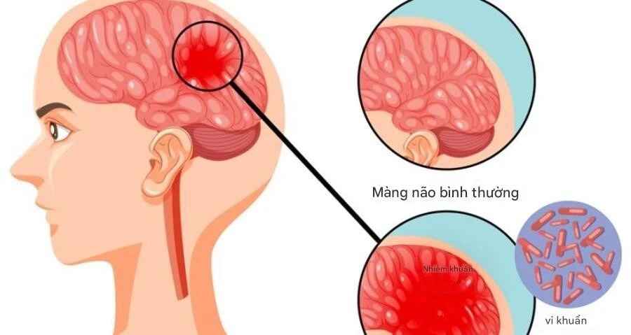 Bệnh n&atilde;o m&ocirc; cầu c&oacute; thể diễn tiến nhanh, cần đặc biệt ch&uacute; &yacute; 4 dấu hiệu n&agrave;y - Ảnh 1.