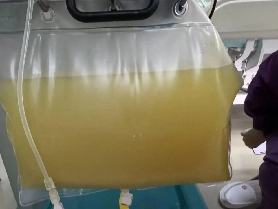 Người phụ nữ 38 tuổi đau bụng dữ dội, máu trắng đục như sữa, bác sĩ cảnh báo nguyên nhân từ thói quen ăn uống quen thuộc- Ảnh 2.