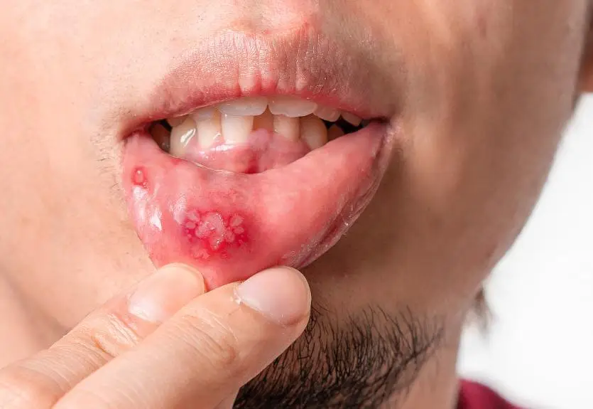 Cơ thể bạn kh&ocirc;ng biết n&oacute;i dối: 3 dấu hiệu phổ biến của hệ miễn dịch suy yếu, h&atilde;y xem bạn c&oacute; bao nhi&ecirc;u trong số đ&oacute; - Ảnh 4.