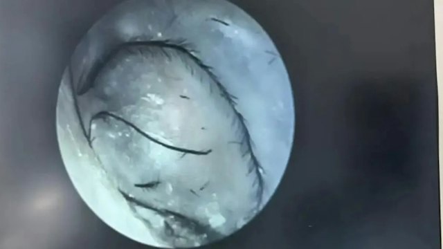 Người phụ nữ ngứa tai đi kh&aacute;m, b&aacute;c sĩ ph&aacute;t hiện thứ bất ngờ b&ecirc;n trong- Ảnh 1.