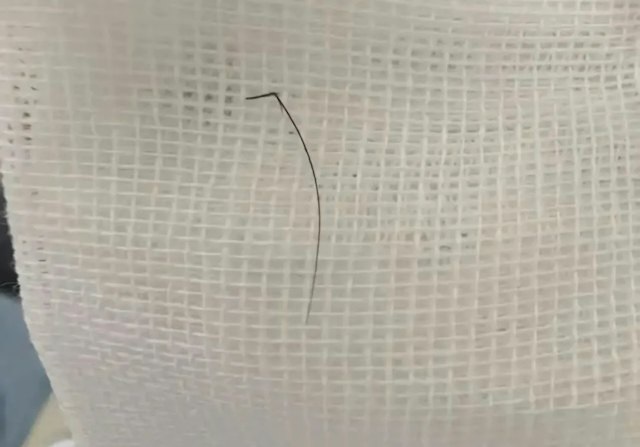 Người phụ nữ ngứa tai đi kh&aacute;m, b&aacute;c sĩ ph&aacute;t hiện thứ bất ngờ b&ecirc;n trong- Ảnh 2.