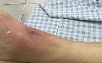 Li&ecirc;n tiếp c&aacute;c trường hợp rết cắn phải nhập viện - Ảnh 1.