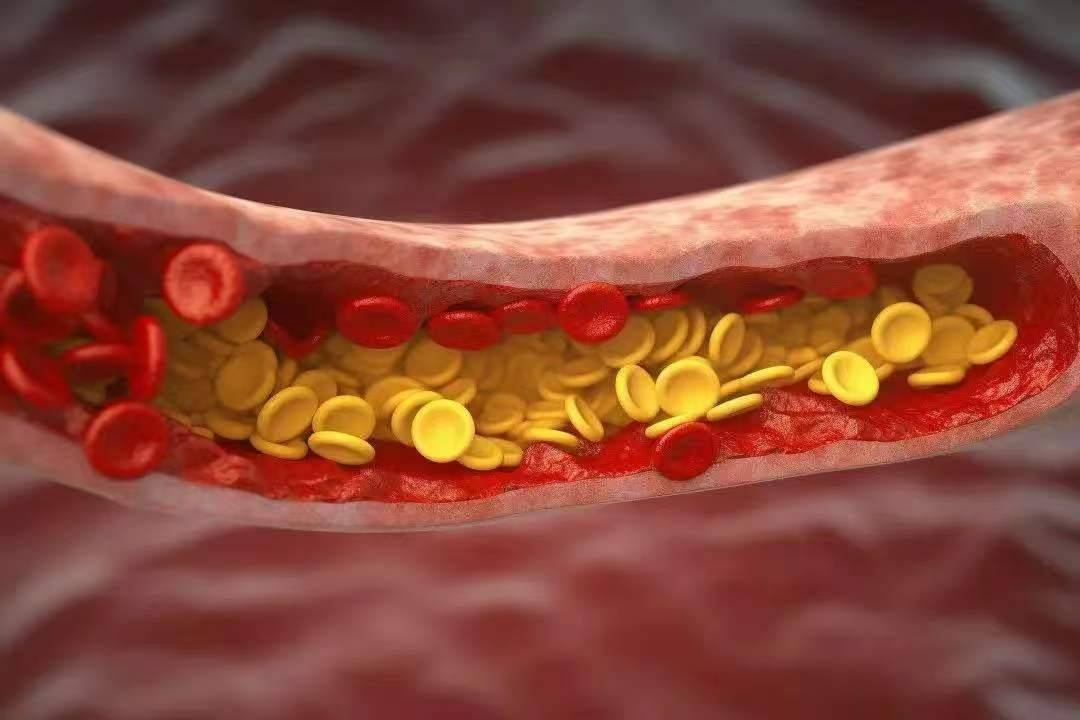 Kh&ocirc;ng phải đi bộ thật nhiều, đ&acirc;y mới l&agrave; 3 việc quan trọng gi&uacute;p l&agrave;m chậm qu&aacute; tr&igrave;nh tắc nghẽn mạch m&aacute;u - Ảnh 1.