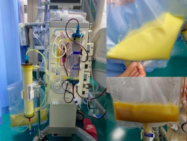 B&eacute; g&aacute;i 12 tuổi m&aacute;u "trắng đục như sữa" v&igrave; thường xuy&ecirc;n ăn m&oacute;n quen thuộc "vạn người m&ecirc;" - Ảnh 1.