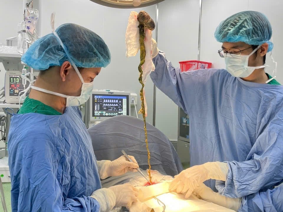 Lấy b&uacute;i t&oacute;c khổng lồ ra khỏi dạ d&agrave;y b&eacute; trai ở Đ&agrave; Nẵng- Ảnh 1.