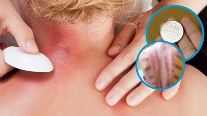 V&igrave; sao đau mỏi người, 'tr&uacute;ng gi&oacute;' d&ugrave;ng đồ bạc, trứng g&agrave; để cạo gi&oacute;?- Ảnh 1.