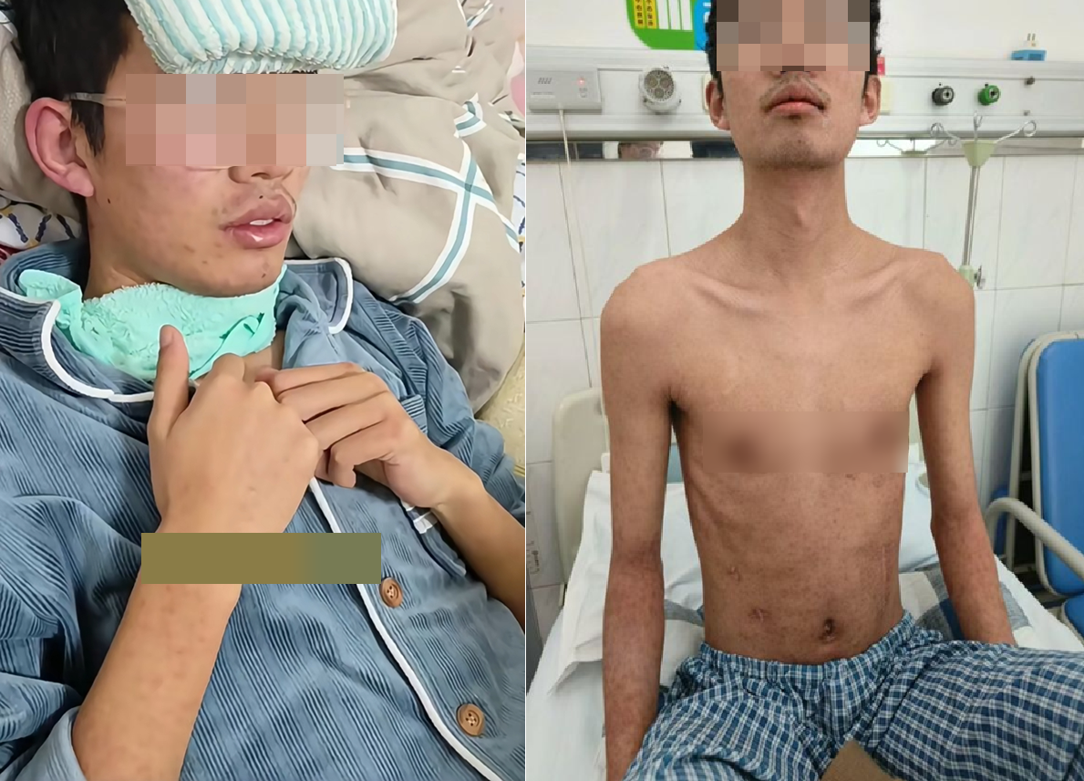 25 tuổi ph&aacute;t hiện ung thư gan giai đoạn cuối, b&aacute;c sĩ x&oacute;t xa n&oacute;i 3 sai lầm đang &acirc;m thầm 