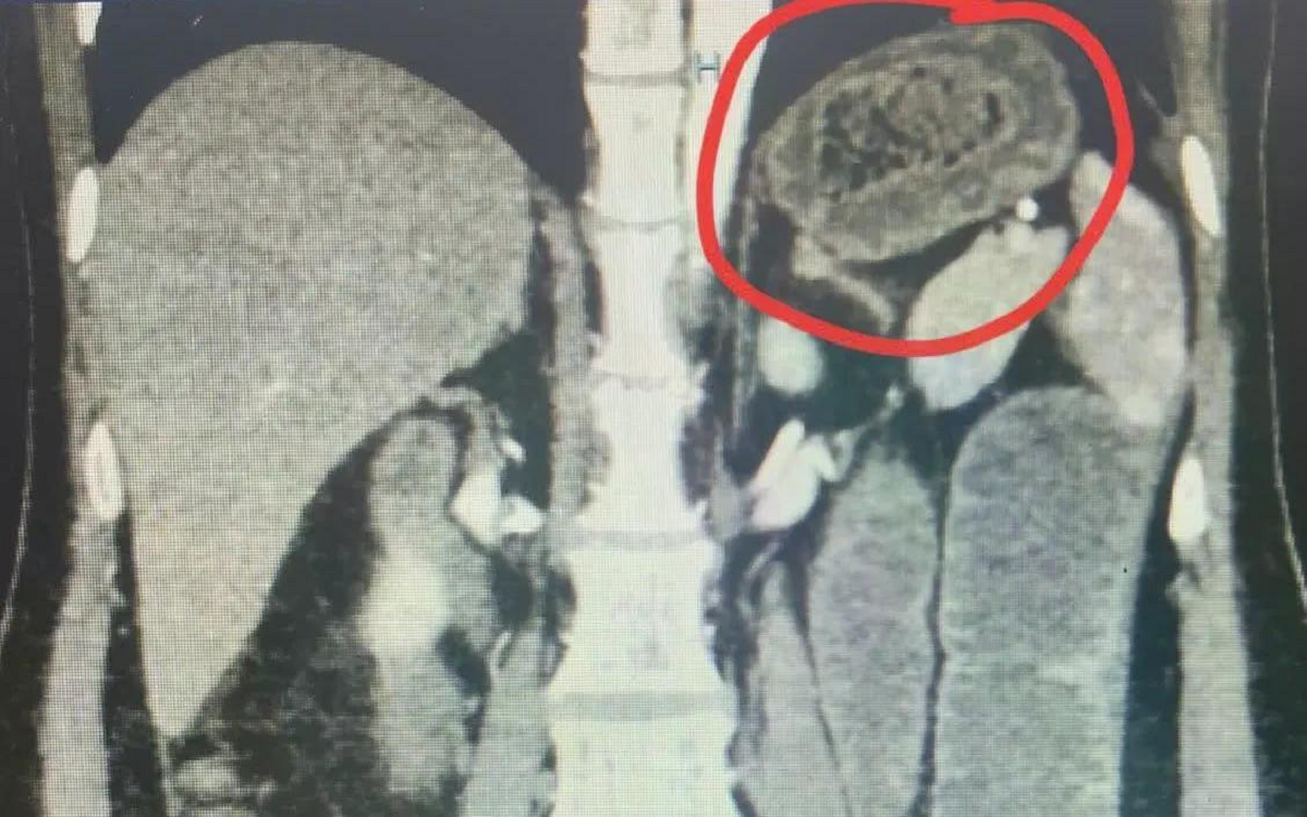 Người đ&agrave;n &ocirc;ng 41 tuổi đau bụng, b&aacute;c sĩ sốc ph&aacute;t hiện ra thứ đ&aacute;ng sợ "đi lạc" trong bụng- Ảnh 2.