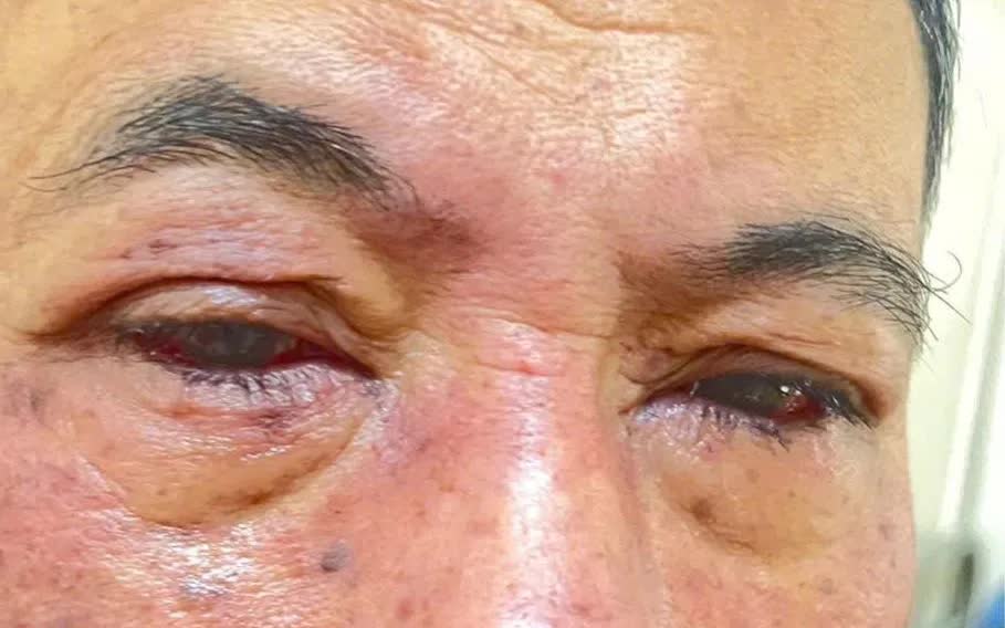 Cảnh b&aacute;o tổn thương mắt do dị ứng thuốc- Ảnh 1.