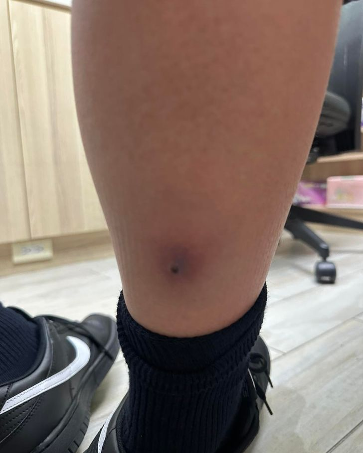 Tưởng chỉ l&agrave; c&uacute;m m&ugrave;a, b&eacute; trai 12 tuổi sốt trở lại: B&aacute;c sĩ v&eacute;n ống quần kiểm tra liền y&ecirc;u cầu cấp cứu khẩn cấp- Ảnh 1.