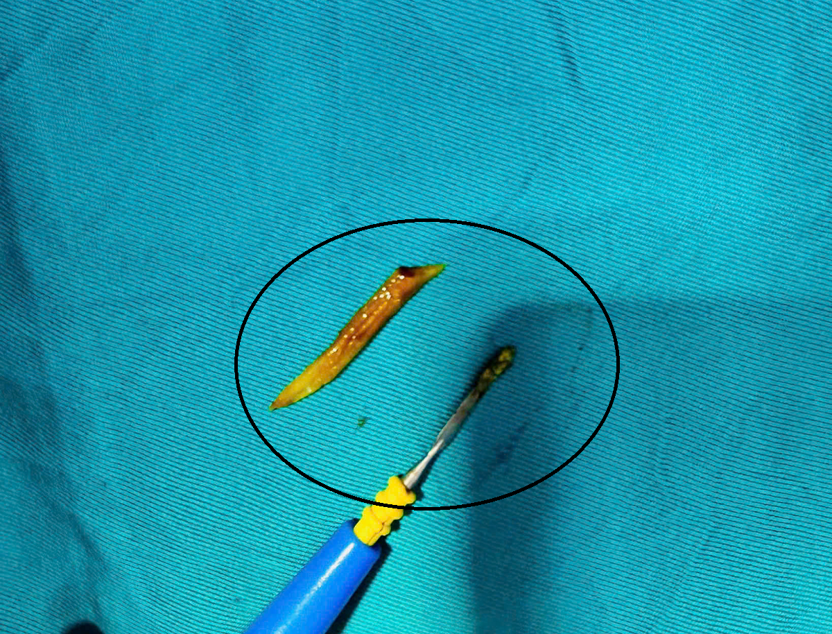 Người đ&agrave;n &ocirc;ng 41 tuổi đau bụng, b&aacute;c sĩ sốc ph&aacute;t hiện ra thứ đ&aacute;ng sợ "đi lạc" trong bụng- Ảnh 1.