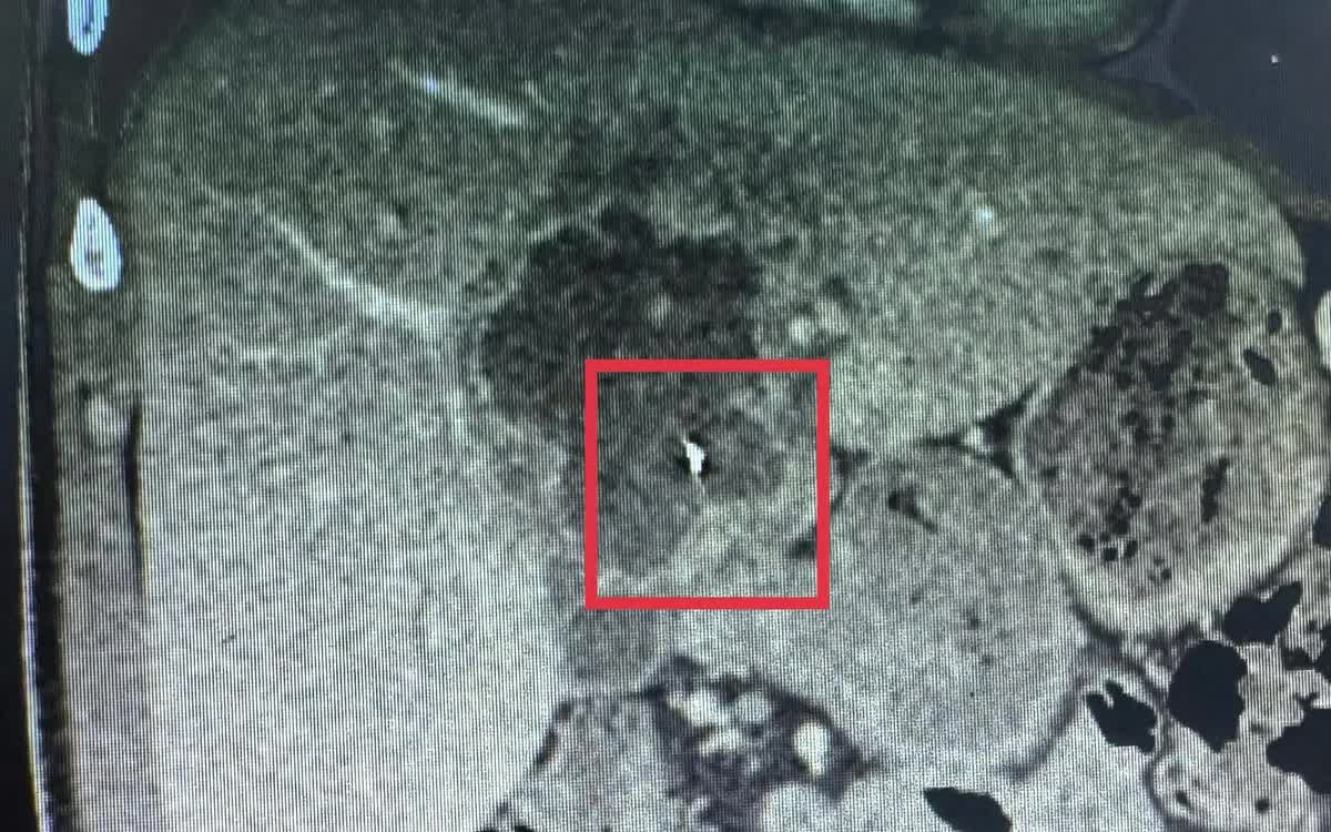 Ca bệnh hiếm gặp: Nội soi lấy dị vật kim loại trong gan- Ảnh 1.