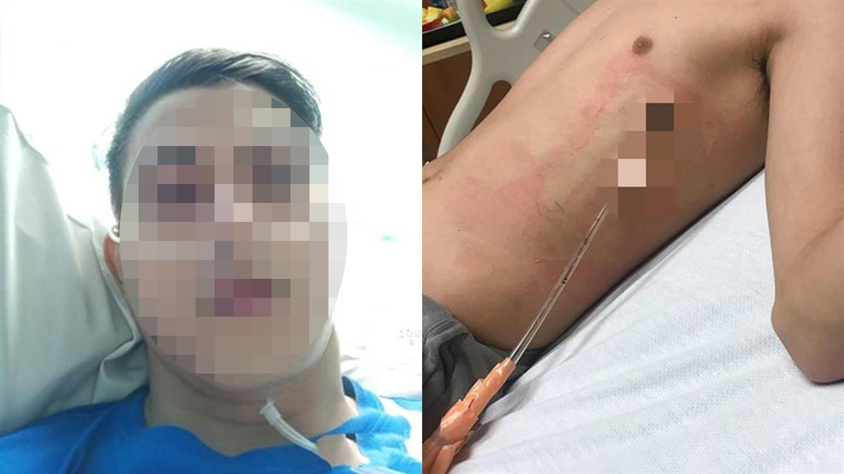 Chỉ vươn vai buổi s&aacute;ng, nam sinh 17 tuổi bị &ldquo;xẹp phổi&rdquo;- Ảnh 1.