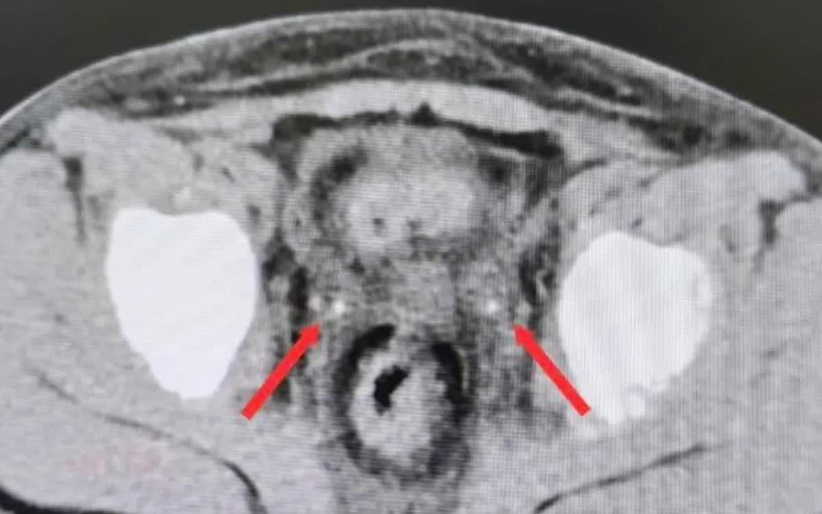 Cực kỳ hiếm: Sỏi niệu quản kẹt hai bên sau mổ viêm ruột thừa khiến bệnh nhi suy thận cấp- Ảnh 1.