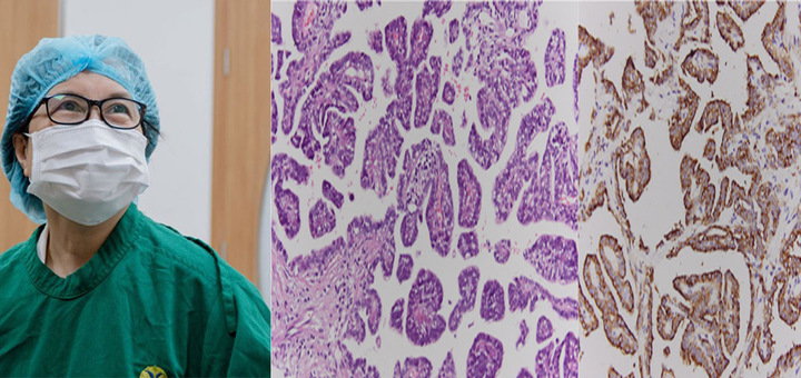 Đi kh&aacute;m vi&ecirc;m dạ d&agrave;y, ph&aacute;t hiện ung thư phổi hiếm gặp- Ảnh 1.