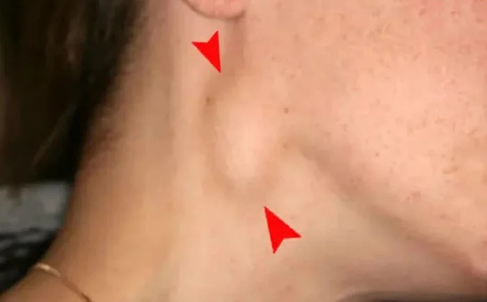 Dấu hiệu cảnh b&aacute;o ung thư v&ograve;m họng tuyệt đối kh&ocirc;ng n&ecirc;n bỏ qua- Ảnh 2.