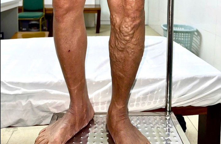 Ch&acirc;n bỗng nổi 'sợi d&acirc;y thừng' ngoằn ngo&egrave;o v&igrave; đứng l&acirc;u, đi lại nhiều- Ảnh 1.