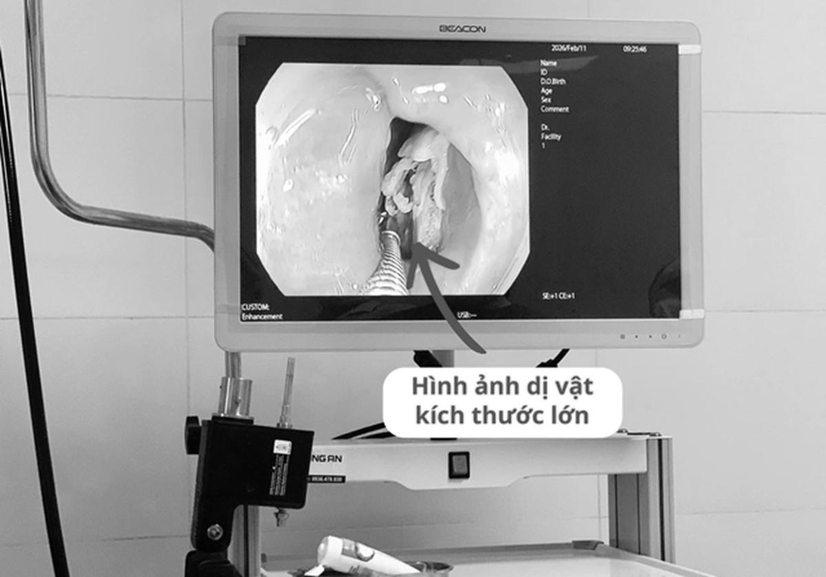 Bệnh nh&acirc;n 16 tuổi đau họng k&eacute;o d&agrave;i, b&aacute;c sĩ ph&aacute;t biện b&iacute; mật "đ&aacute;ng sợ" b&ecirc;n trong- Ảnh 1.