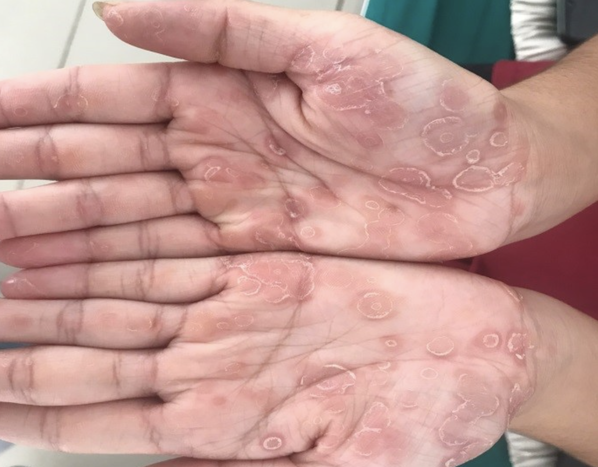 B&eacute; trai 3 tuổi bị giang mai bẩm sinh d&ugrave; kh&ocirc;ng c&oacute; triệu chứng- Ảnh 1.