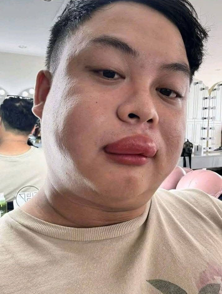 C&ocirc; d&acirc;u bị ong đốt, thợ make up đến &ldquo;cứu&rdquo; cũng bị đốt sưng m&ocirc;i: Người trong cuộc kể chuyện hy hữu- Ảnh 2.