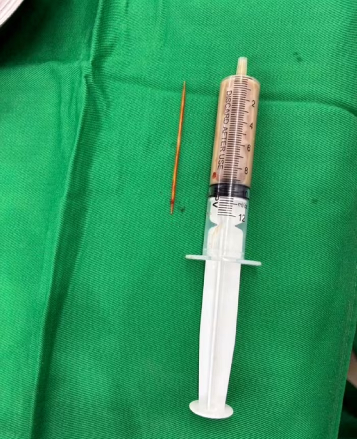 Người đ&agrave;n &ocirc;ng bụng "cứng như đ&aacute;" 2 tuần, b&aacute;c sĩ ph&aacute;t hiện nguy&ecirc;n nh&acirc;n bất ngờ- Ảnh 1.