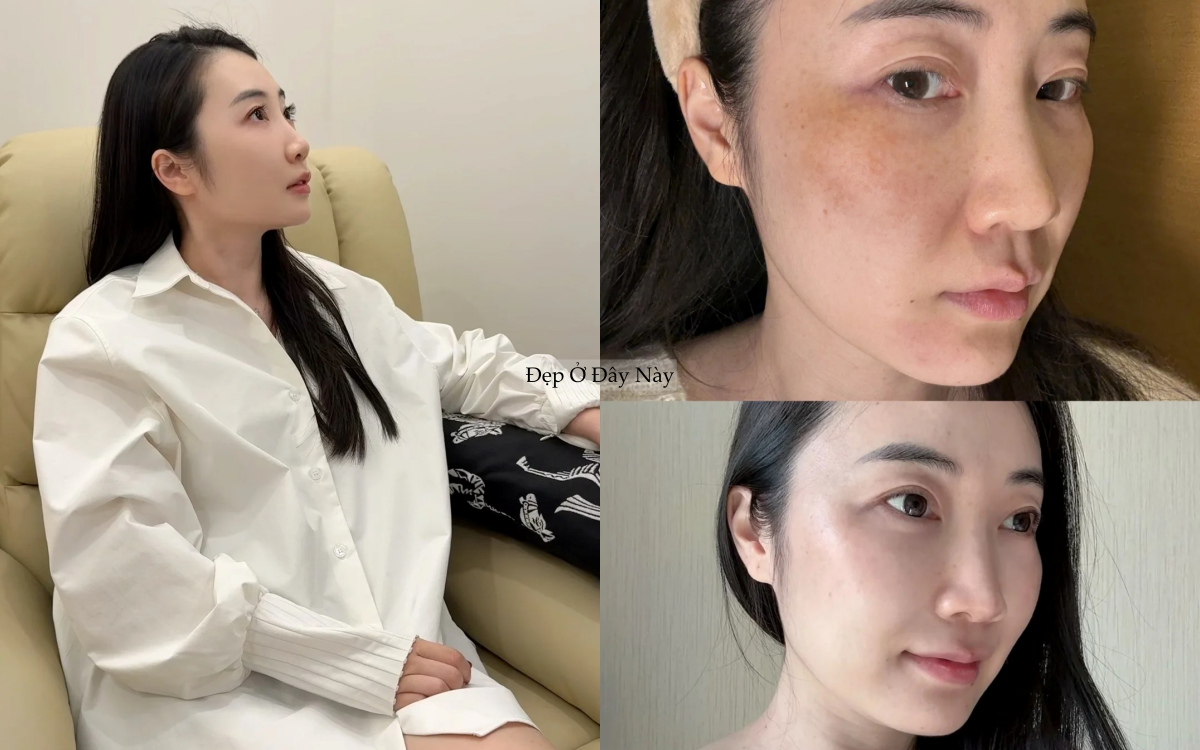 1 năm ki&ecirc;n tr&igrave; d&ugrave;ng loại 4 serum dưỡng s&aacute;ng n&agrave;y, n&aacute;m m&aacute; 2 b&ecirc;n của t&ocirc;i đỡ hẳn- Ảnh 2.