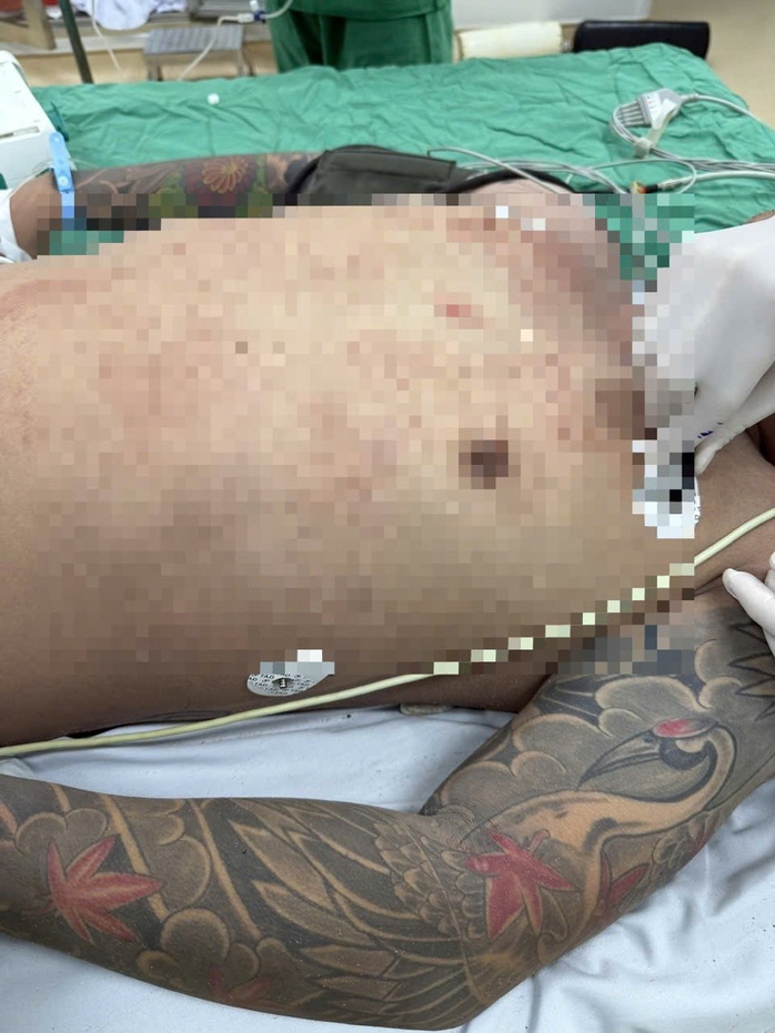 Cứu sống 1 nam bệnh nh&acirc;n nguy kịch do thủng tim- Ảnh 1.