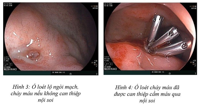 16 tuổi đ&atilde; xuất huyết dạ d&agrave;y v&agrave; cảnh b&aacute;o từ b&aacute;c sĩ- Ảnh 1.