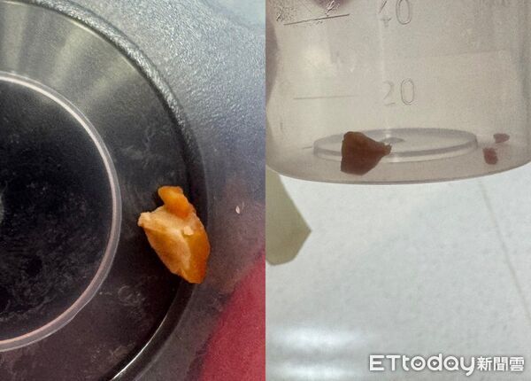 B&agrave; cho ch&aacute;u trai 1 tuổi ăn một hạt lạc, phổi của ch&aacute;u bắt đầu xẹp! B&aacute;c sĩ bức x&uacute;c: Đ&acirc;y kh&ocirc;ng biết l&agrave; trường hợp thứ bao nhi&ecirc;u!- Ảnh 1.