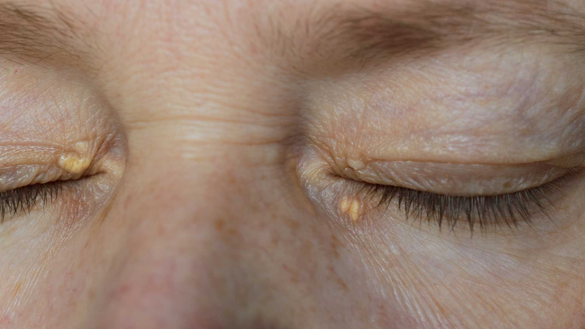 7 dấu hiệu của người c&oacute; mỡ m&aacute;u cao: Sau 40 tuổi nếu kh&ocirc;ng c&oacute; th&igrave; xin ch&uacute;c mừng!- Ảnh 2.