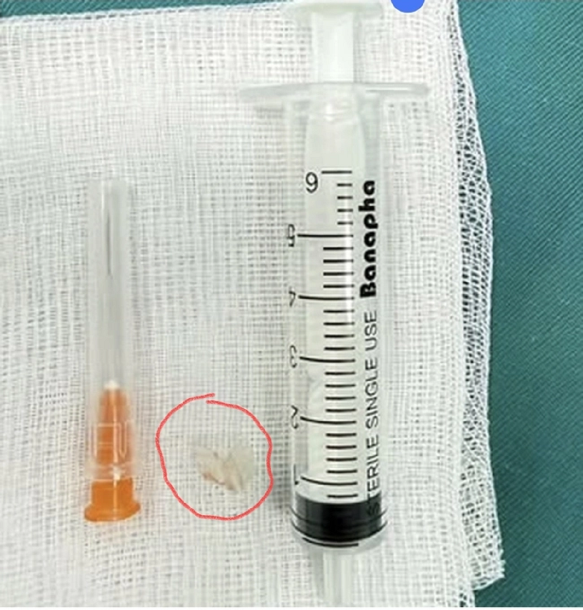 B&eacute; trai 7 tuổi xẹp phổi tr&aacute;i, b&aacute;c sĩ gắp ra thứ "đ&aacute;ng sợ" b&ecirc;n trong- Ảnh 1.