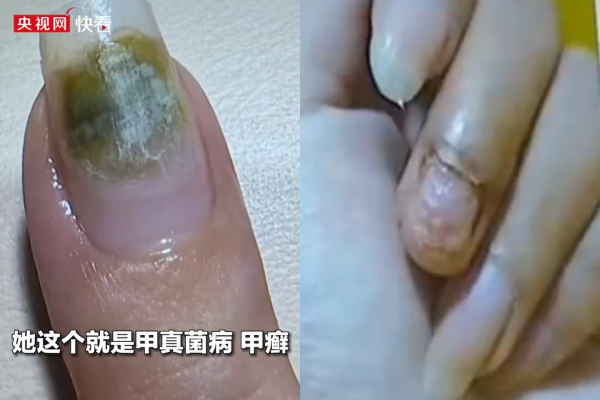 Trung Quốc: Tiệm nail khiến nhiều người nhiễm HPV do khử tr&ugrave;ng dụng cụ l&agrave;m m&oacute;ng qua loa- Ảnh 1.