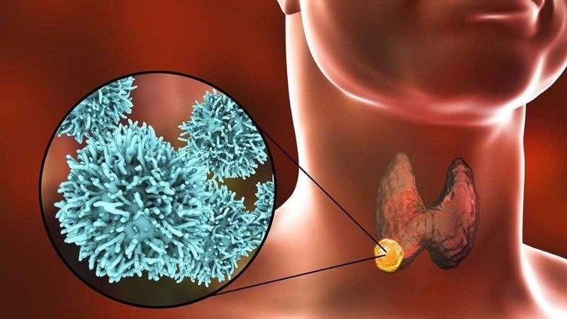 Nhiều người đi si&ecirc;u &acirc;m ph&aacute;t hiện c&oacute; nang gi&aacute;p, b&aacute;c sĩ chỉ ngay 5 dấu hiệu cảnh b&aacute;o cần đi kh&aacute;m lại ngay lập tức- Ảnh 1.