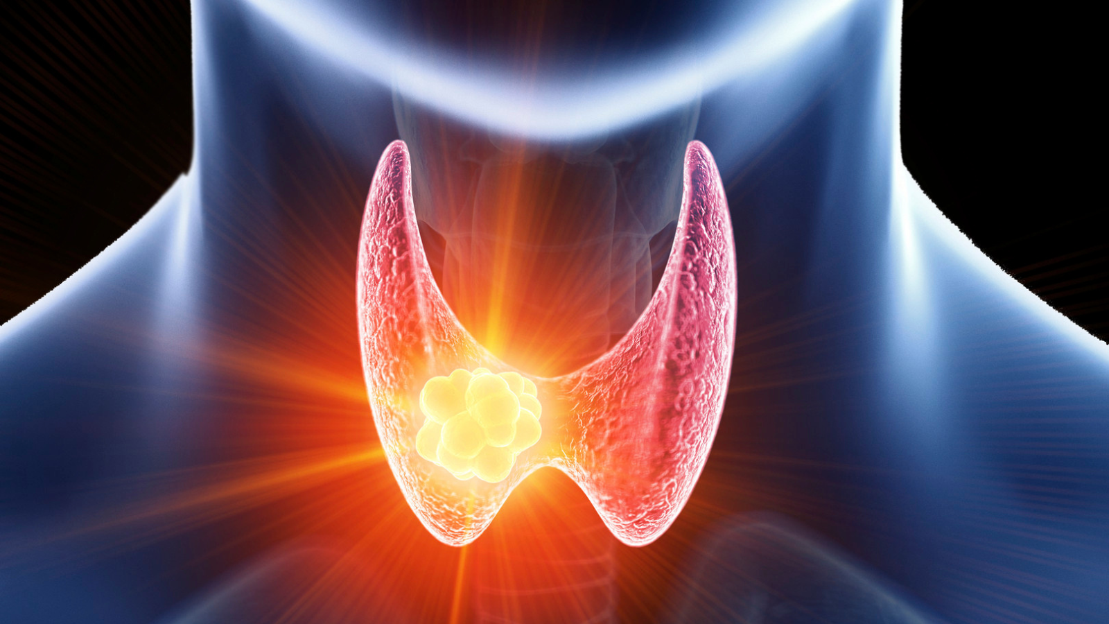 Nhiều người đi si&ecirc;u &acirc;m ph&aacute;t hiện c&oacute; nang gi&aacute;p, b&aacute;c sĩ chỉ ngay 5 dấu hiệu cảnh b&aacute;o cần đi kh&aacute;m lại ngay lập tức- Ảnh 3.