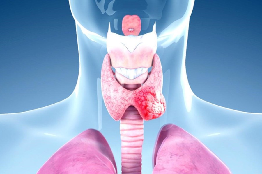 Nhiều người đi si&ecirc;u &acirc;m ph&aacute;t hiện c&oacute; nang gi&aacute;p, b&aacute;c sĩ chỉ ngay 5 dấu hiệu cảnh b&aacute;o cần đi kh&aacute;m lại ngay lập tức- Ảnh 4.