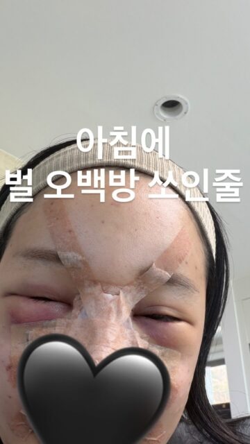 Tr&ugrave;ng tu nhan sắc để ăn Tết, 1 sao nữ mặt mũi biến dạng, sưng phồng như bị 