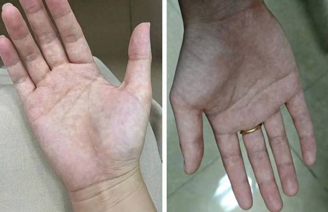 B&agrave;n tay l&agrave; t&iacute;n hiệu cảnh b&aacute;o sức khỏe: 1 thay đổi c&oacute; thể cho thấy bệnh tiểu đường hoặc xơ gan- Ảnh 4.