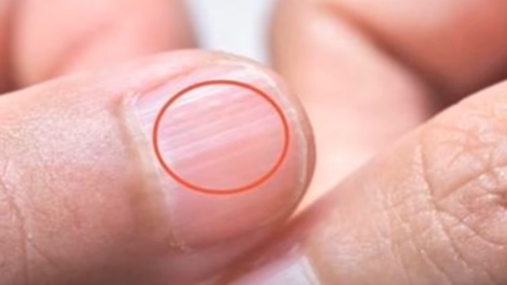 B&agrave;n tay l&agrave; t&iacute;n hiệu cảnh b&aacute;o sức khỏe: 1 thay đổi c&oacute; thể cho thấy bệnh tiểu đường hoặc xơ gan- Ảnh 3.