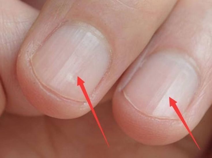 B&agrave;n tay l&agrave; t&iacute;n hiệu cảnh b&aacute;o sức khỏe: 1 thay đổi c&oacute; thể cho thấy bệnh tiểu đường hoặc xơ gan- Ảnh 2.