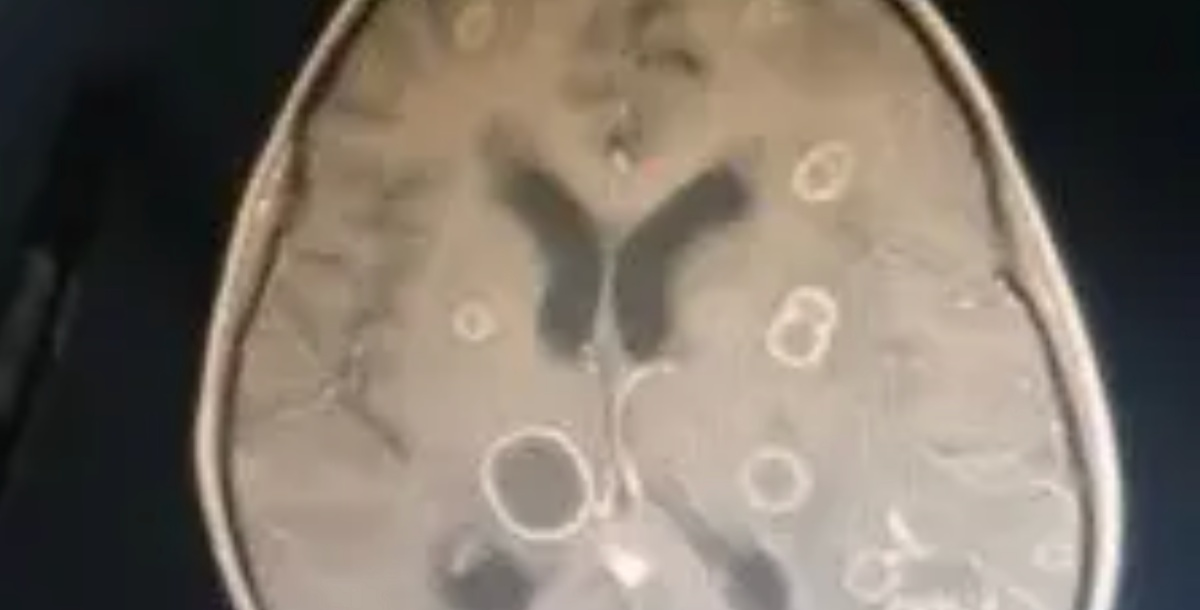 Dọn dẹp nh&agrave; đ&oacute;n Tết, b&eacute; g&aacute;i lớp 2 bị "ăn m&ograve;n 20 lỗ thủng" ở n&atilde;o- Ảnh 1.