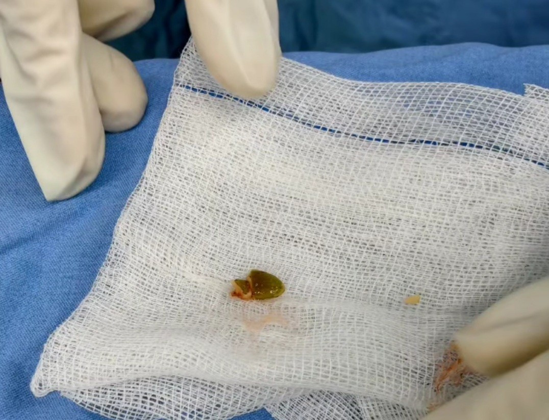 Nhiều trẻ nhỏ h&oacute;c hạt b&iacute;, hạt mắc ca nhập viện- Ảnh 1.